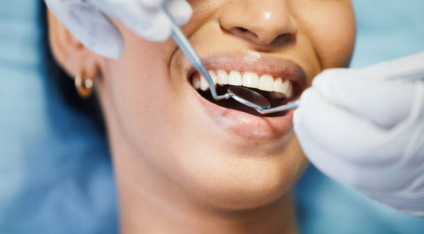 Best Emergency Dentist for Lost Fillings or Crowns in Egon City, OR